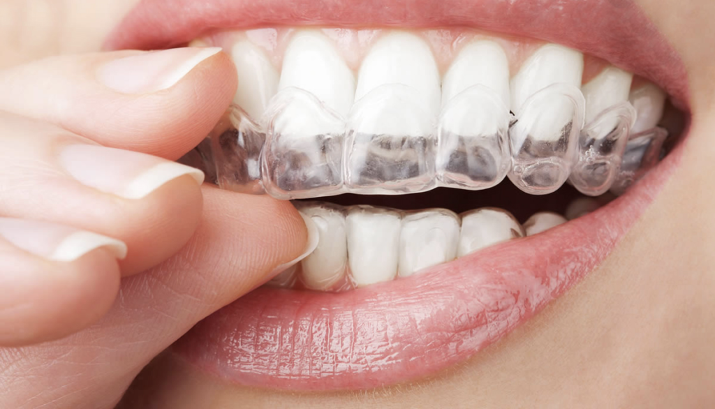 Clear Aligners in Lahore