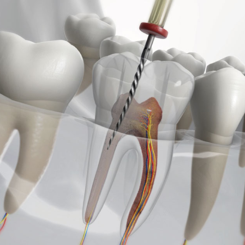 root canal treatment in DHA Lahore