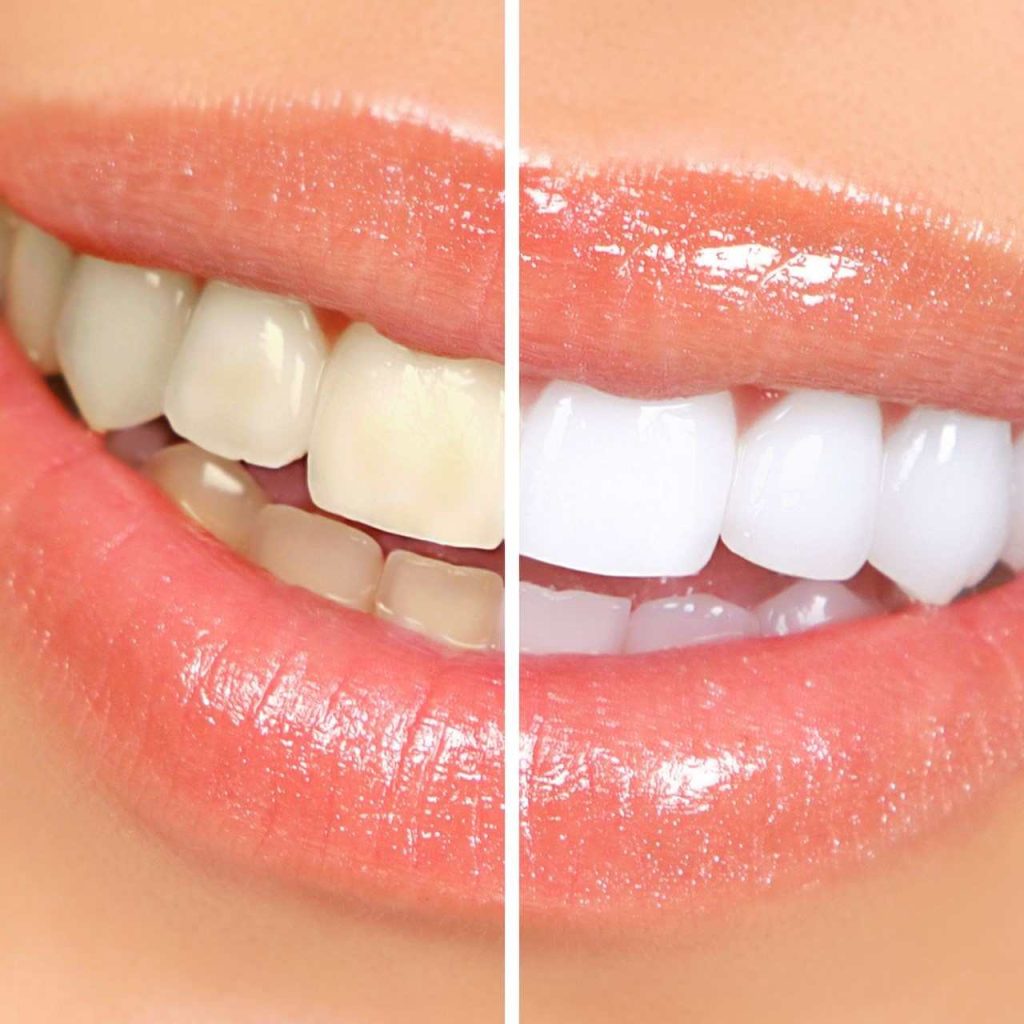 teeth whitening price in lahore