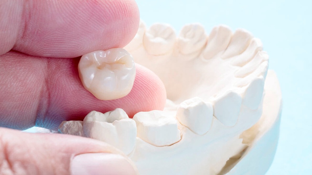 Dental Crowns Treatment in Lahore