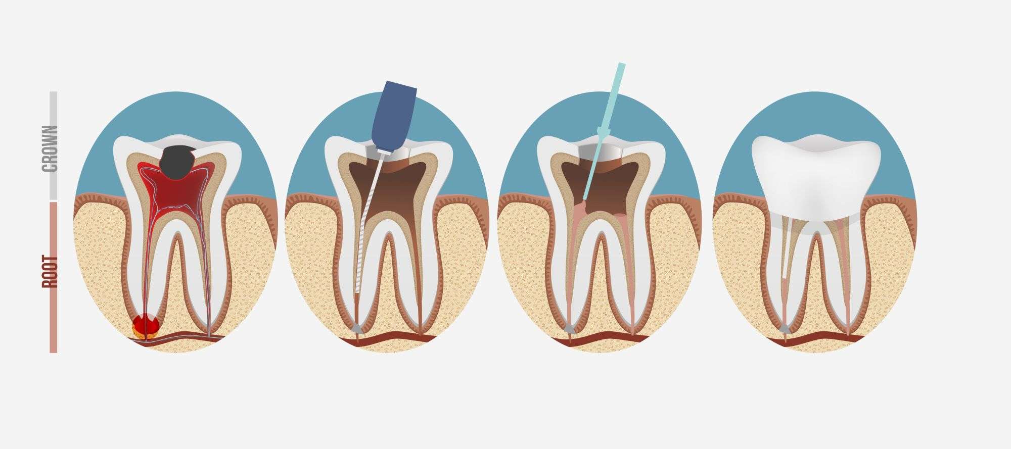 root canal treatment in lahore