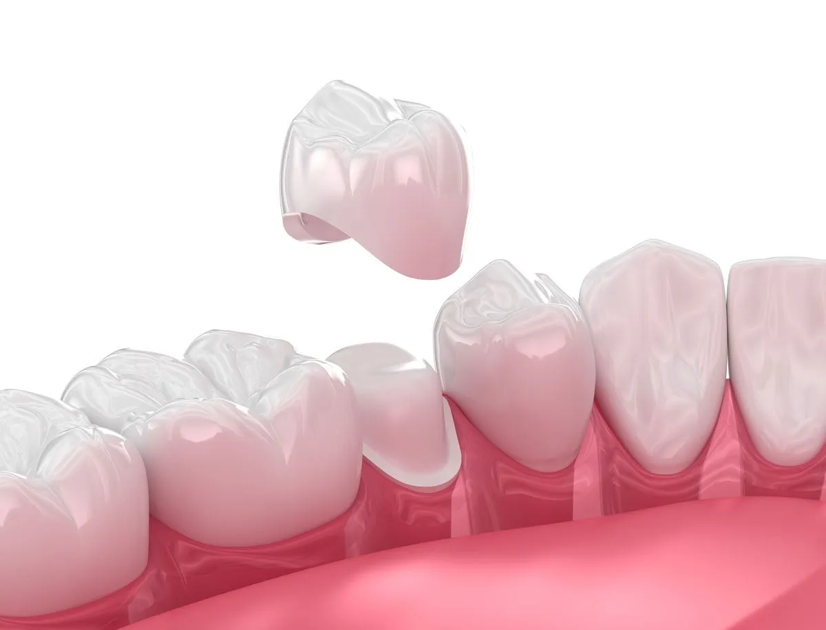 Dental Crowns Treatment in Lahore