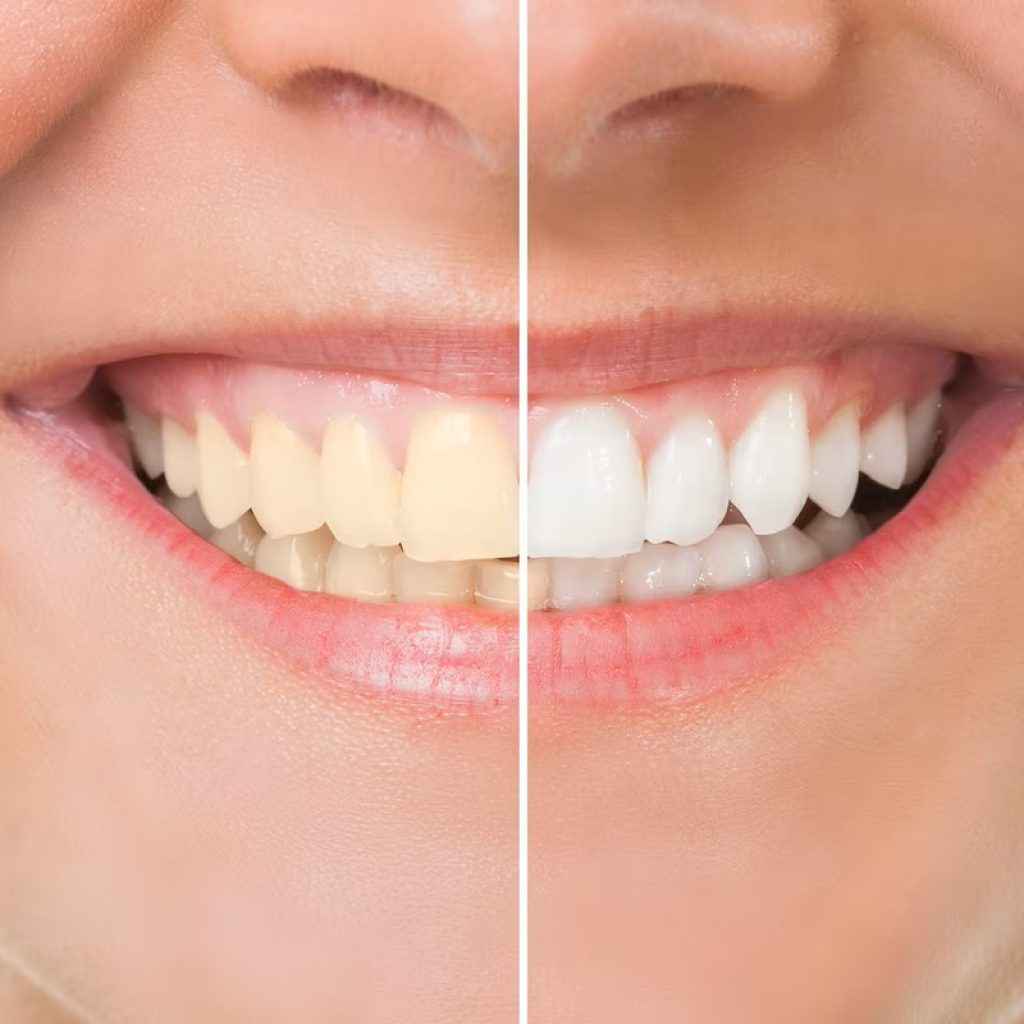 teeth whitening price in Lahore