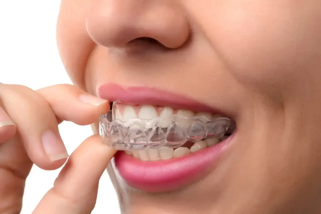 Clear Aligners Treatment in Lahore